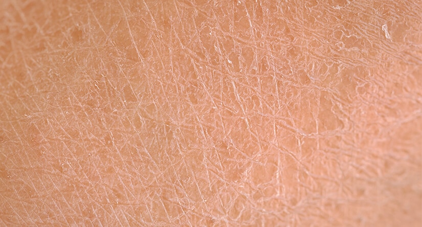 Come prendersi cura della pelle secca: cause, trattamento e consigli di prevenzione